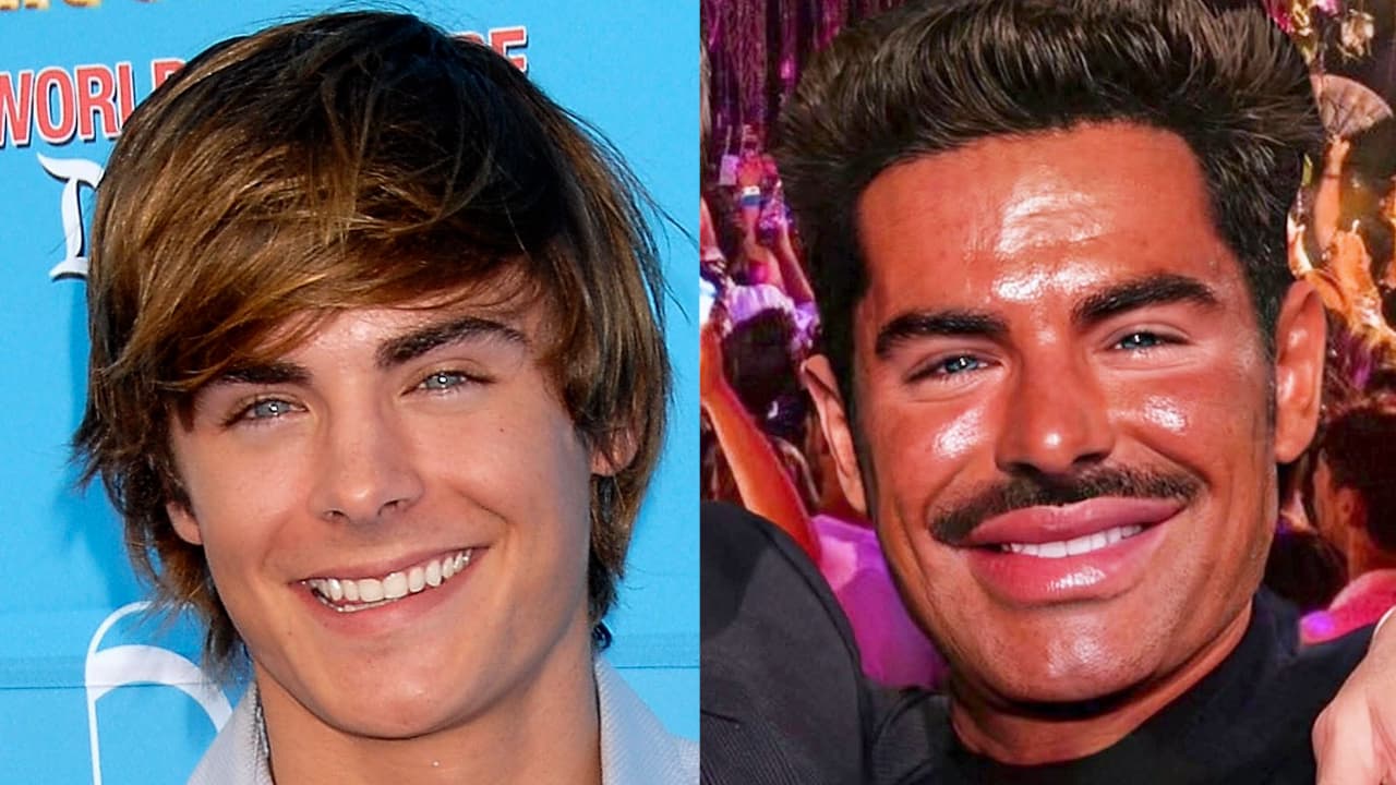 La transformación de Zac Efron: los cambios en su rostro tras sufrir accidente