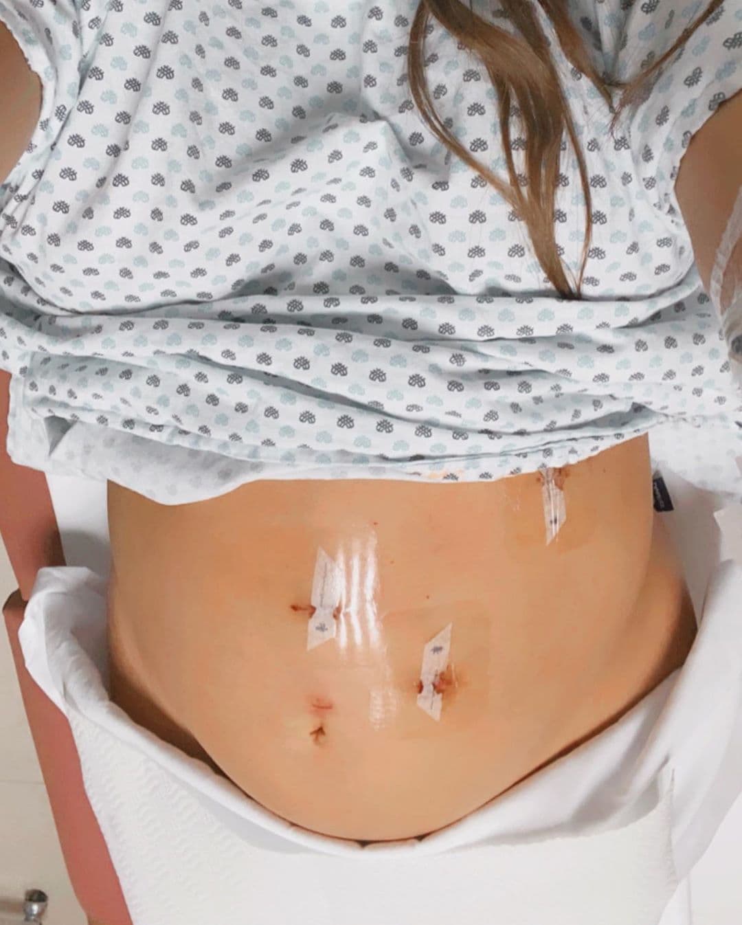 El pasado 3 de septiembre, la integrante de la Familia Disfuncional compartió que debía someterse a una operación de emergencia debido a un cuadro de apendicitis en su semana 33 de embarazo. “Creo que las cicatrices son como las heridas de batalla, hermosas en cierto sentido, muestran por dónde has pasado y qué tan fuerte eres por haber salido de ahí. Esta es el antes y el después de Lucca en una de las pruebas más fuertes que hemos tenido”, expresó.