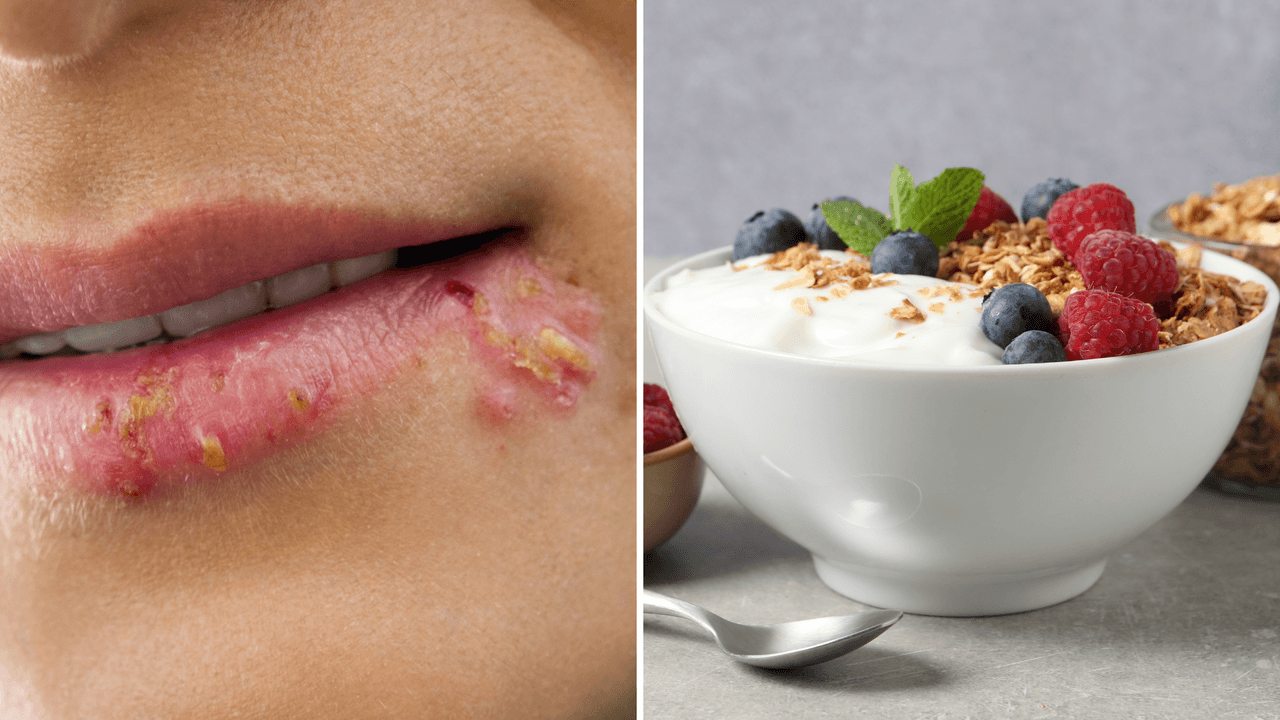 Las personas propensas a tener herpes deben comer estos 11 alimentos que bloquean el virus