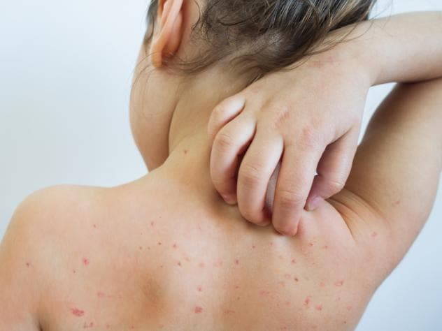 El auge del movimiento antivacunas, así como una mutación en el virus, ha hecho que los casos de sarampión repunten. Se trata de una enfermedad que se creía controlada.