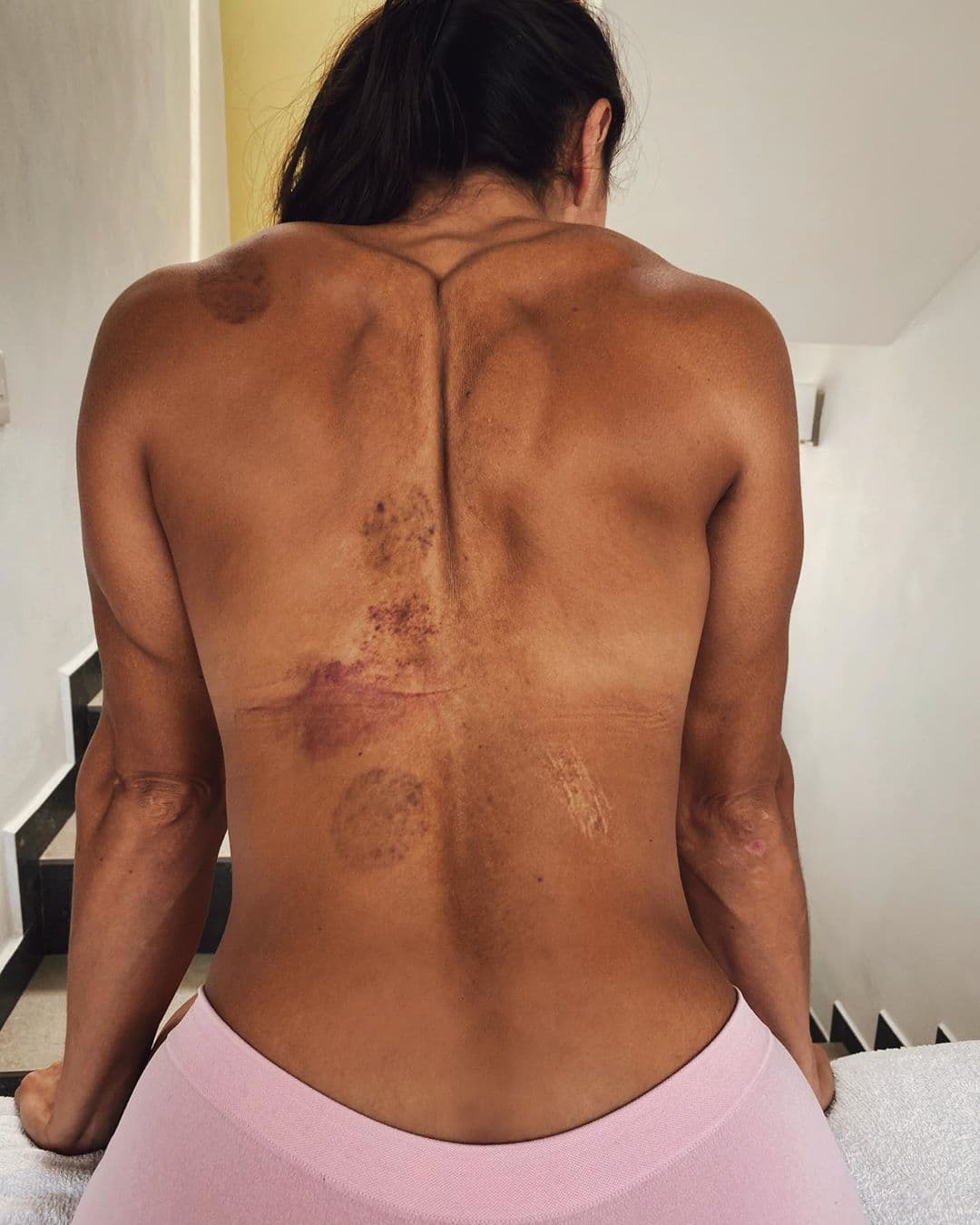 En la competencia puede haber algunas lesiones y Macky no teme ocultarlas. El pasado 25 de julio, la capitana de Cobras mostró los moretones de su espalda. “#APruebaDeBalas Nadie derrumba a quien Dios levanta”, expresó.