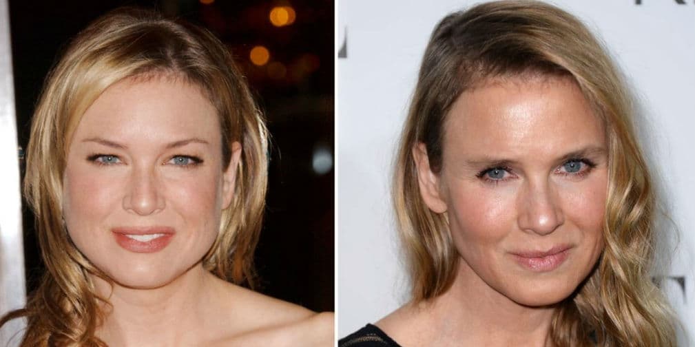 5. Renée Zellweger: A sus 45 años de edad, la rubia parece ser amante de las cirugías estéticas.