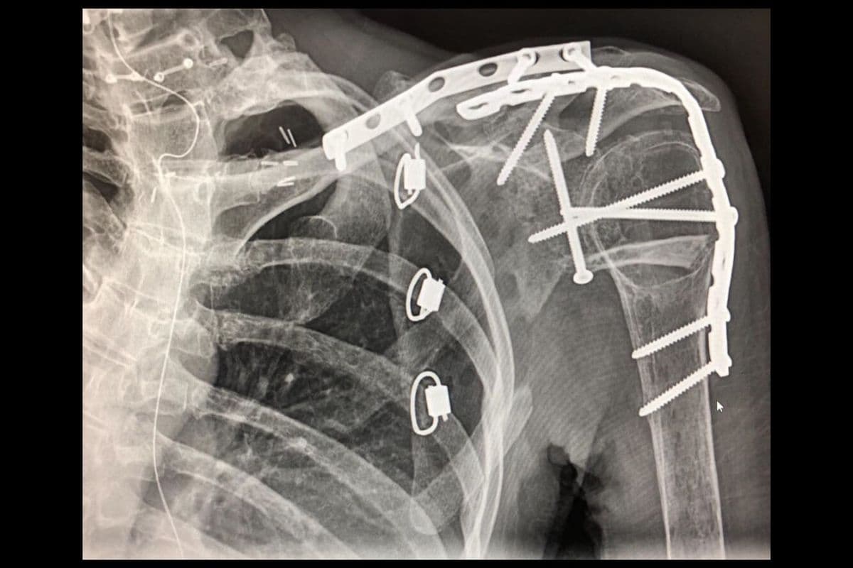Olivia estuvo 17 días en coma, con una parte de su cuerpo paralizada, los pulmones perforados, sus costillas rotas y perdió el brazo hasta por encima del codo, le quedaron algunas cicatrices en la cara y aún sufre daños nerviosos.